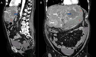 Case report: Urgent liver pathologies: All in one